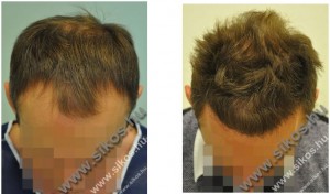 Hajbeültetési beavatkozások